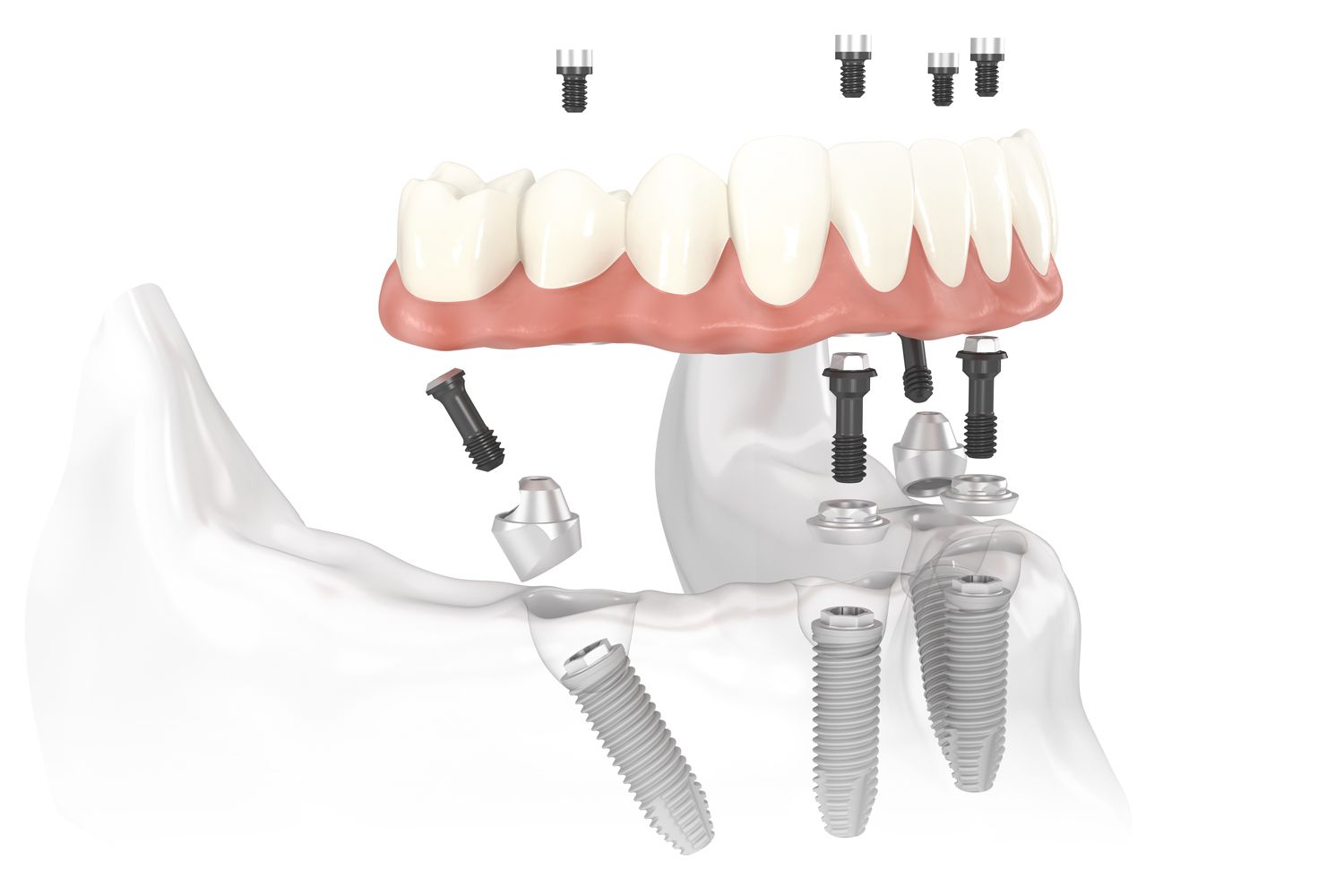 Illustration of angled implants